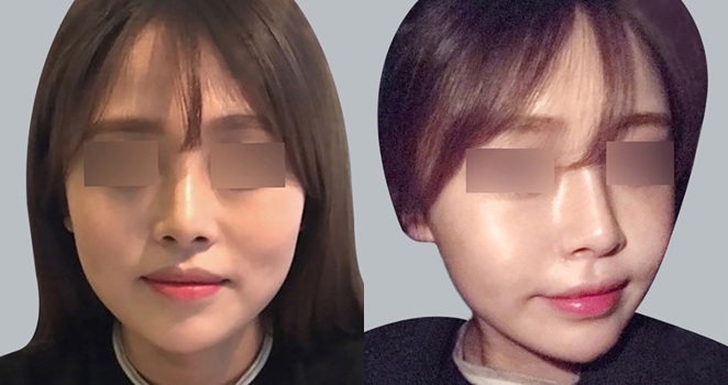 큐오필 필러