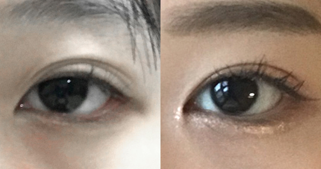비절개 눈매교정+앞트임