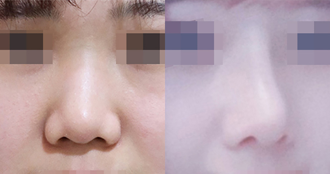 코성형