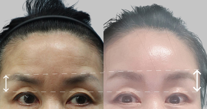 눈썹 이마거상술