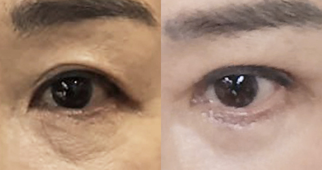 상안검+하안검