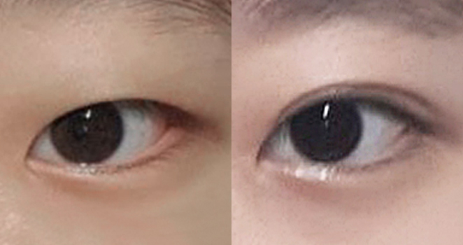눈매교정+앞트임