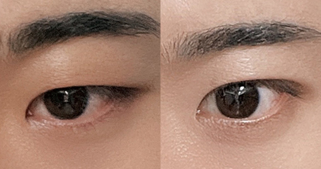 비절개 눈매교정