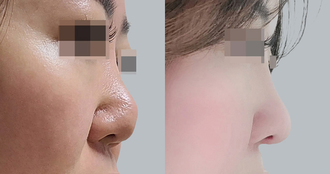 개방코성형