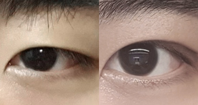 비절개 눈매교정