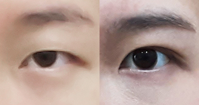 절개 눈매교정