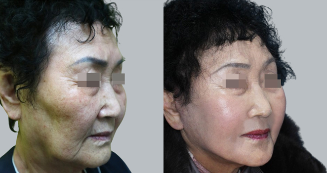안면거상술