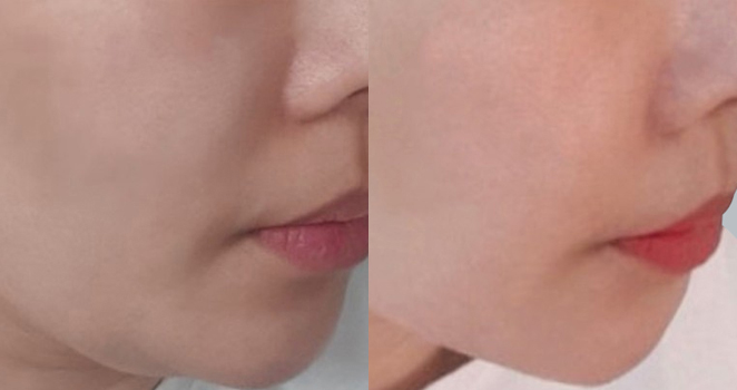 이중턱흡입+실리프팅