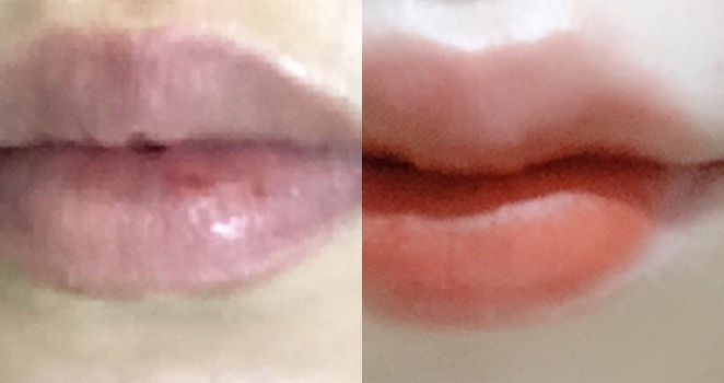 입술필러