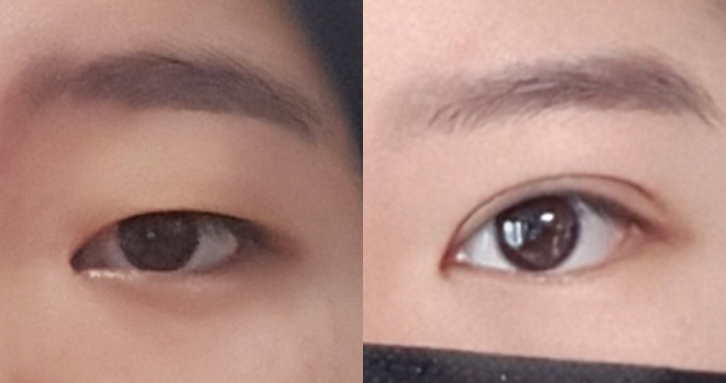절개 눈매교정