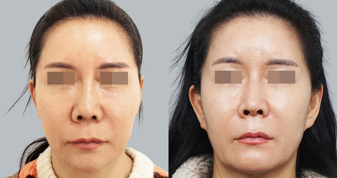 노플란트+휜코교정+자가늑연골 재수술
