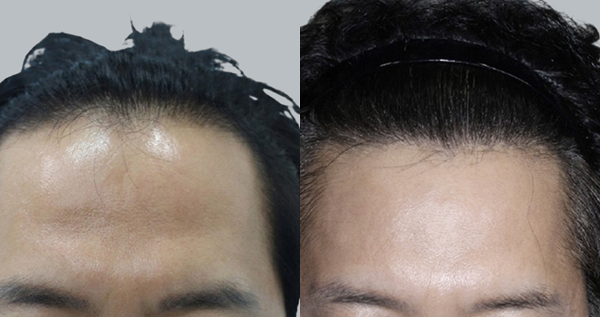 남성 모발이식 절개 3000모