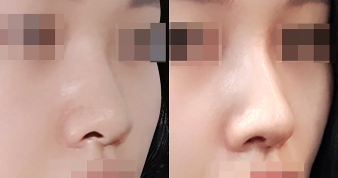 개방코성형