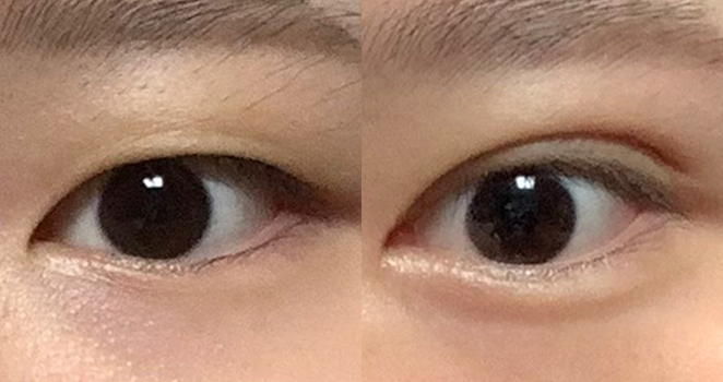 절개 쌍꺼풀+앞트임