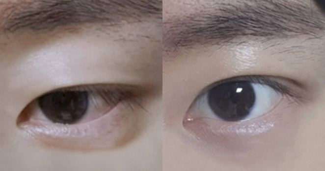 비절개 눈매교정