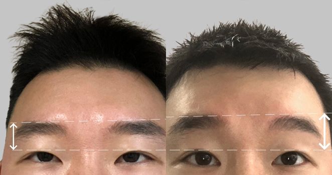 눈썹 이마거상술