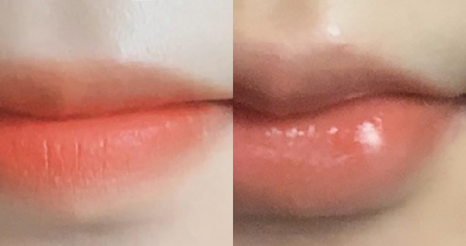 입술필러