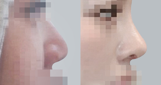 코성형
