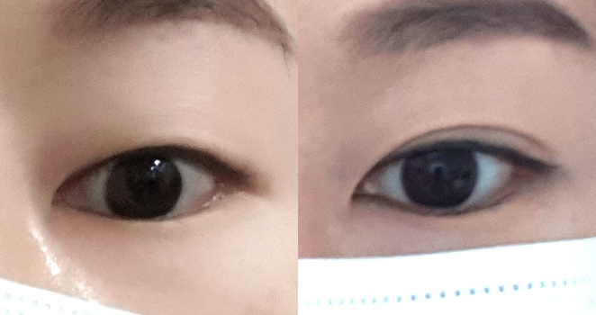 비절개 눈매교정