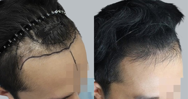남성 모발이식 절개 2740모