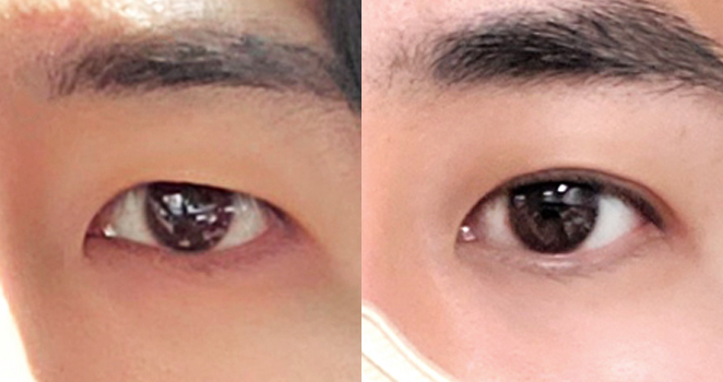 비절개 눈매교정