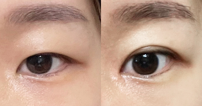 절개 눈성형+윗트임