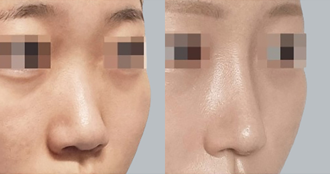 개방코성형
