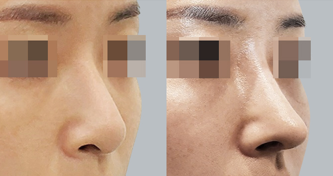 개방코성형