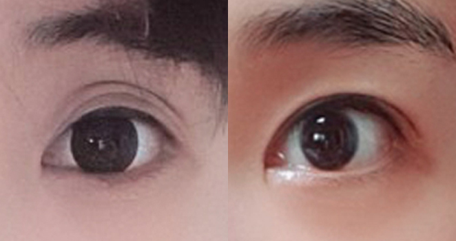 절개 눈재수술