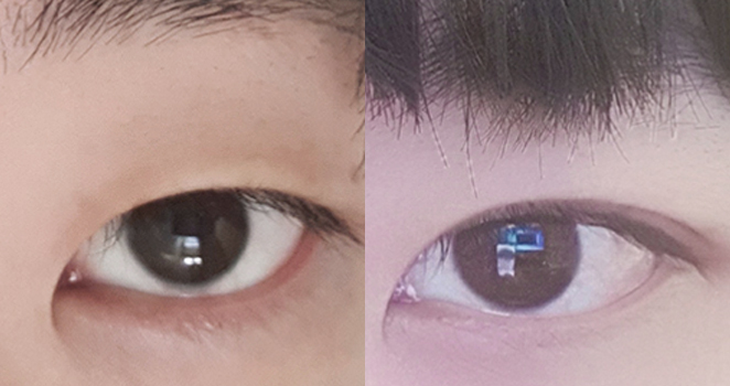 비절개 눈매교정