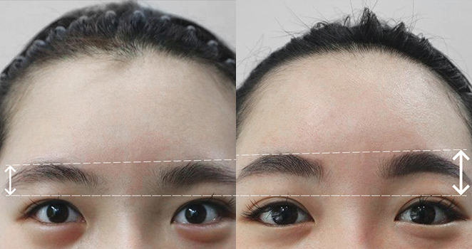 눈썹 이마거상술