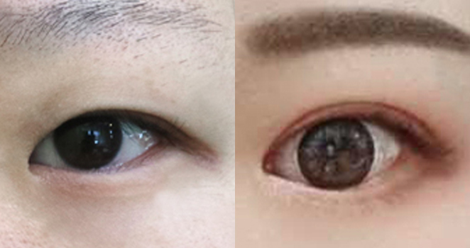 절개 쌍꺼풀+앞트임