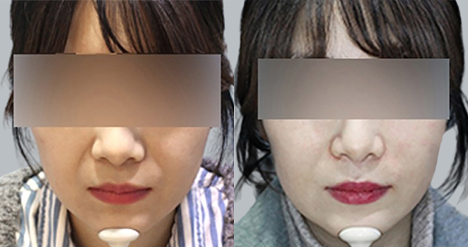 팔자 필러