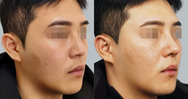 개방코성형+기증늑연골