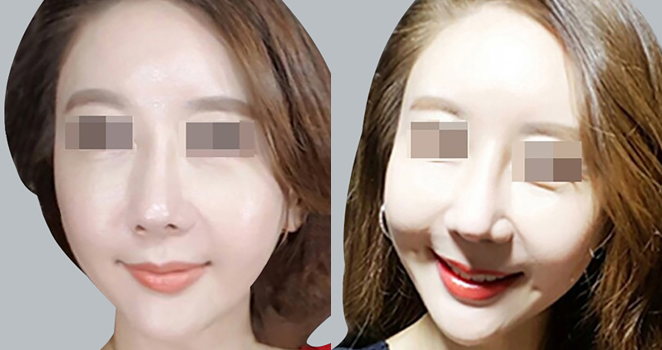 보조개