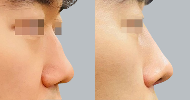개방코성형+매부리