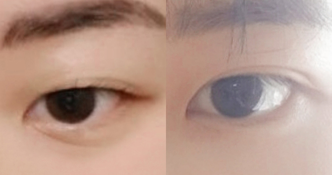 매몰 쌍꺼풀