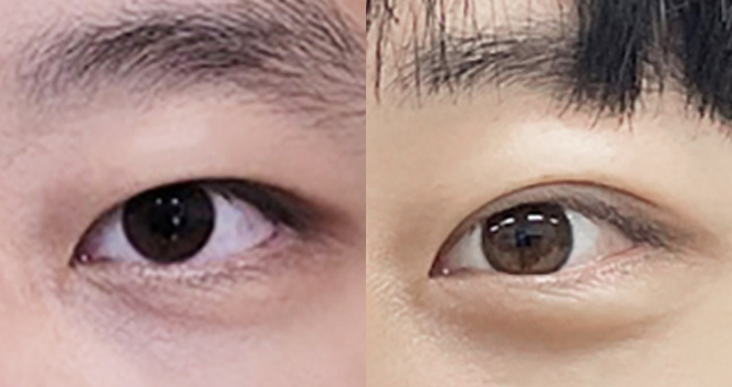 비절개 눈매교정