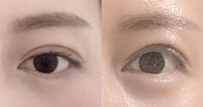 상안검+눈매교정 재수술
