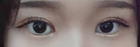 절개눈매교정+앞트임 3개월 후