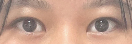 절개눈매교정+앞트임 6개월 후