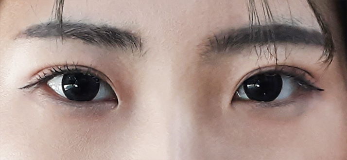 매몰 눈성형 3개월 후