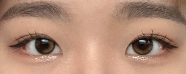 비절개 눈매교정 6개월 후