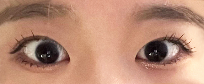 절개눈매교정 3개월 후