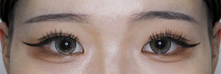 절개눈매교정+눈재수술 3개월 후