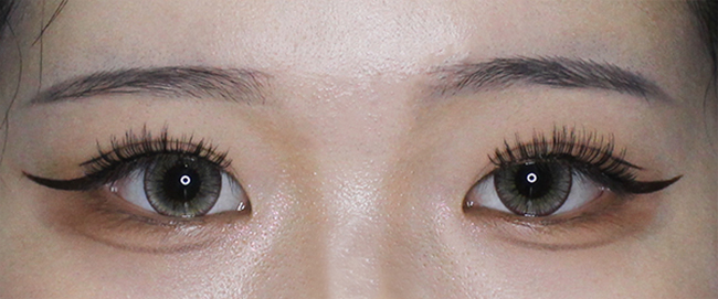 절개눈매교정+눈재수술 3개월 후