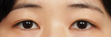 절개앞트임 3개월 후