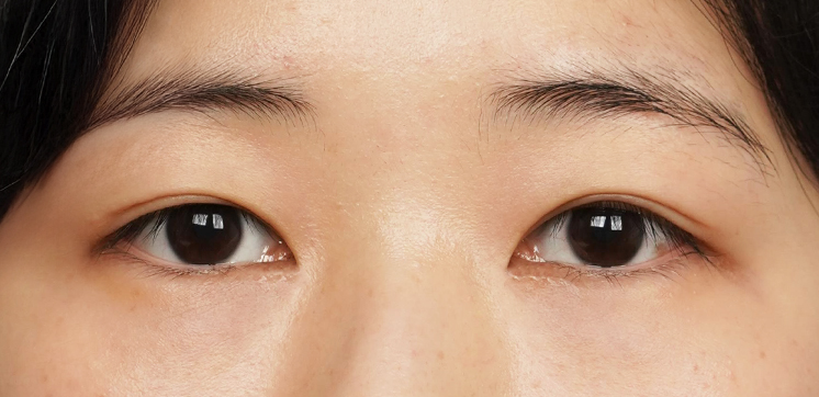 절개앞트임 3개월 후