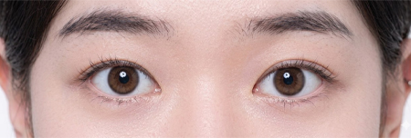 절개눈매교정 + 앞트임 5개월 후