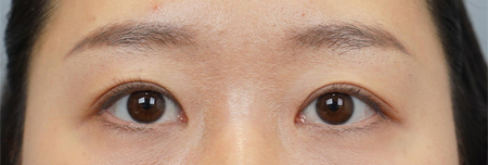 상안검재수술 + 윗트임 6개월 후